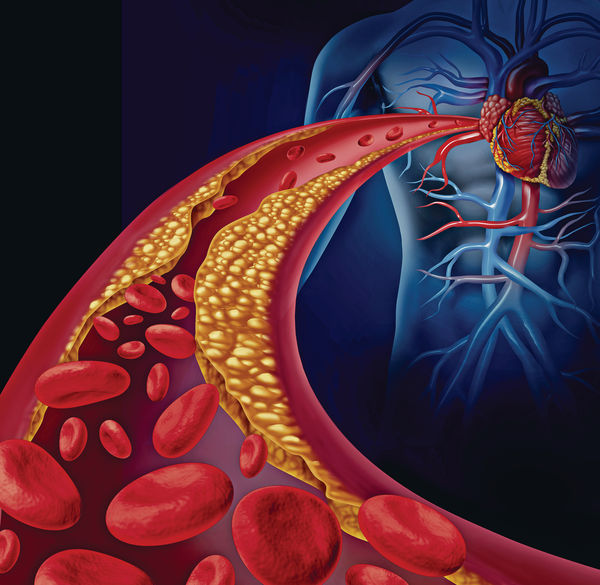 「长者属高血脂高危族降胆固醇减心血管病风险」