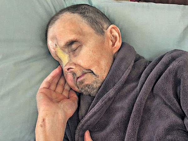 亨特因体弱而不适宜接受面部重整手术,变成「独眼疤面男」.